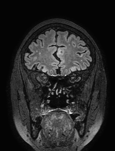 Cavernous hemangioma of the cerebellar falx (Radiopaedia 73025-83724 Coronal FLAIR 81).jpg