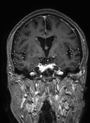 Cavernous hemangioma of the cerebellar falx (Radiopaedia 73025-83724 Coronal T1 C+ 172).jpg