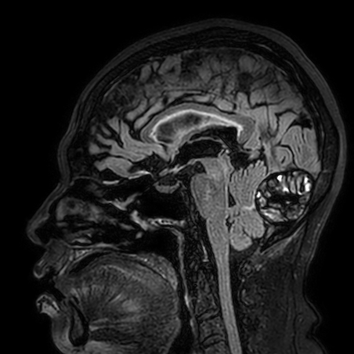 Cavernous hemangioma of the cerebellar falx (Radiopaedia 73025-83724 Sagittal FLAIR 110).jpg