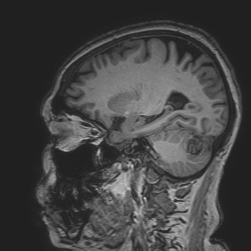 File:Cavernous hemangioma of the cerebellar falx (Radiopaedia 73025-83724 Sagittal T1 73).jpg