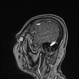 File:Cavernous sinus meningioma (Radiopaedia 63682-72367 Sagittal T1 C+ 40).jpg