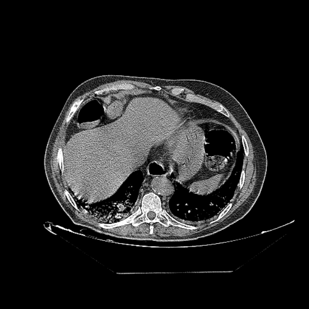 Cavitating bronchogenic carcinoma (Radiopaedia 44489-48162 Axial non-contrast 71).jpg