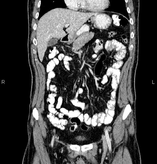 Cecal adenocarcinoma (Radiopaedia 85324-100916 D 20).jpg