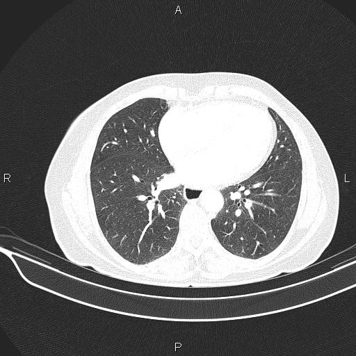 Cecal cancer (Radiopaedia 85610-101358 Axial lung window 42).jpg