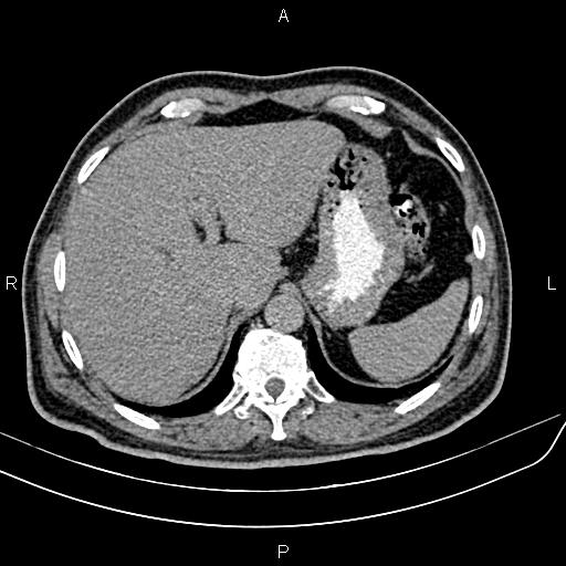 File:Cecal cancer with appendiceal mucocele (Radiopaedia 91080-108651 Axial C+ delayed 1).jpg
