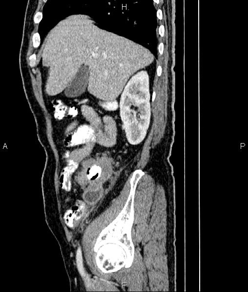 Cecal cancer with appendiceal mucocele (Radiopaedia 91080-108651 E 25).jpg