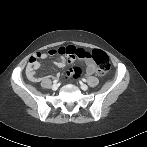 Cecal internal hernia through the foramen of Winslow (Radiopaedia 44820-48651 B 54).png