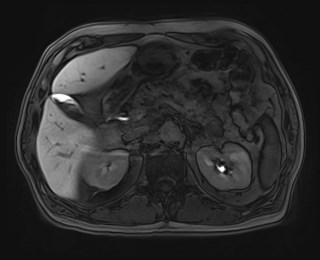 Cecal mass causing appendicitis (Radiopaedia 59207-66532 K 46).jpg