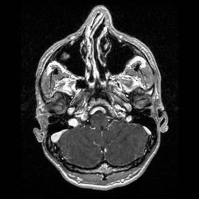 File:Central-variant posterior reversible encephalopathy syndrome (PRES) (Radiopaedia 43880-47358 Axial T1 C+ 21).jpg