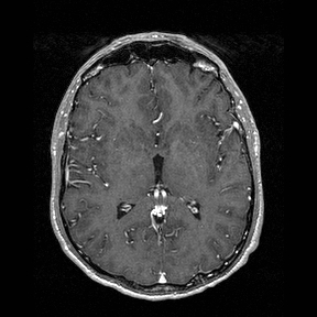 Central-variant posterior reversible encephalopathy syndrome (PRES) (Radiopaedia 43880-47358 Axial T1 C+ 83).jpg
