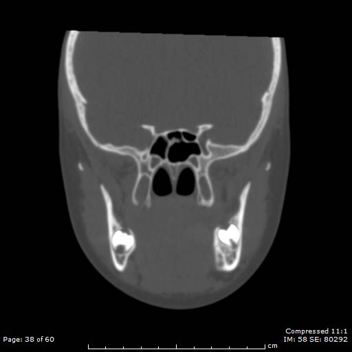 Central giant cell granuloma (Radiopaedia 45612-49754 Coronal bone window 38).jpg