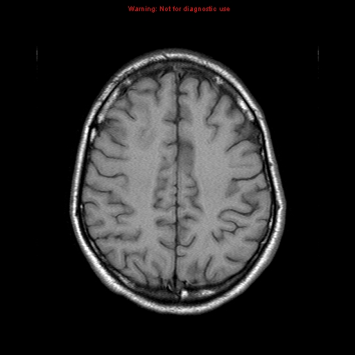 File:Central nervous system vasculitis (Radiopaedia 8410-9235 Axial T1 18).jpg