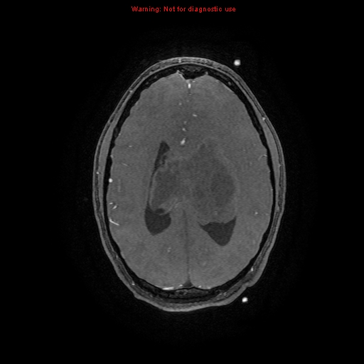 Central neurocytoma (Radiopaedia 13188-13206 Axial MRA 3).jpg