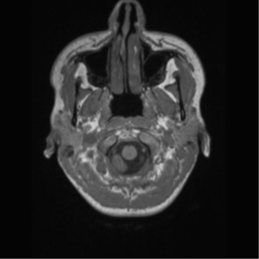 File:Central neurocytoma (Radiopaedia 37664-39557 Axial T1 4).png