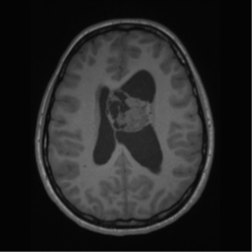 File:Central neurocytoma (Radiopaedia 37664-39557 Axial T1 46).png