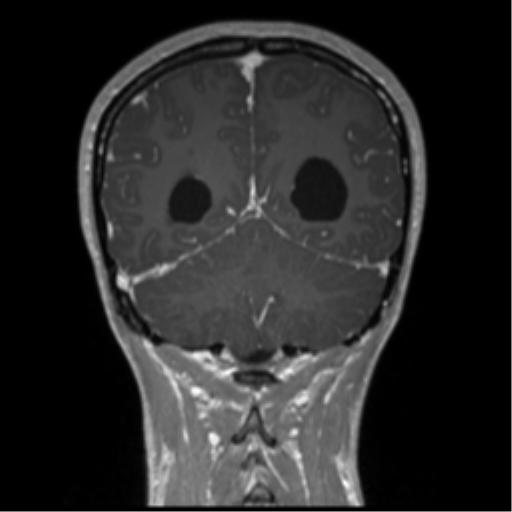 Central neurocytoma (Radiopaedia 37664-39557 Coronal T1 C+ 24).png
