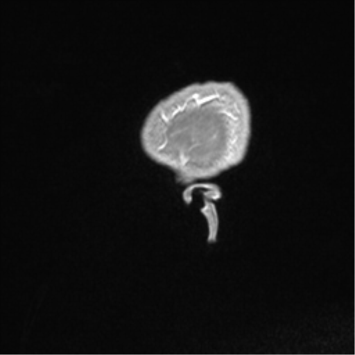 Central neurocytoma (Radiopaedia 37664-39557 Sagittal T1 C+ 92).png