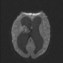 Central neurocytoma (Radiopaedia 56690-63469 Axial DWI 49).jpg