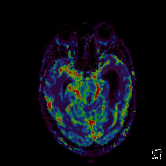 Central neurocytoma (Radiopaedia 84497-99872 Axial Perfusion 204).jpg