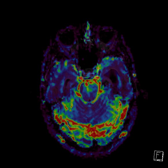 Central neurocytoma (Radiopaedia 84497-99872 Axial Perfusion 223).jpg