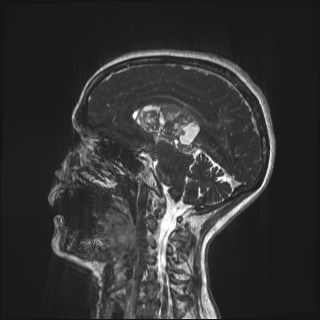 File:Central neurocytoma (Radiopaedia 84497-99872 Sagittal CISS 34).jpg