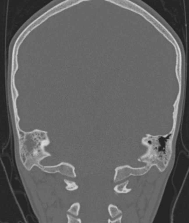 Cerebellar abscess (Radiopaedia 73727-84527 Coronal bone window 36).jpg
