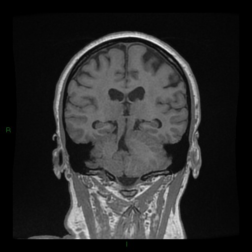 File:Cerebellar abscess (Radiopaedia 78135-90678 Coronal T1 C+ 100).jpg