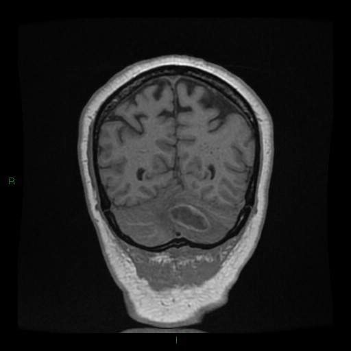 Cerebellar abscess (Radiopaedia 78135-90678 Coronal T1 C+ 132).jpg
