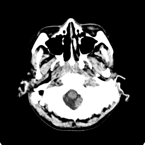 Cerebellar abscess secondary to mastoiditis (Radiopaedia 26284-26412 Axial non-contrast 14).jpg