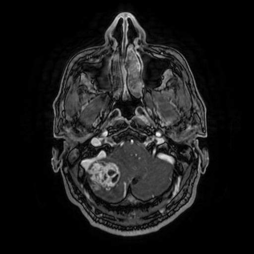 Cerebellar hemangioblastoma (Radiopaedia 88055-104622 Axial T1 C+ 38).jpg