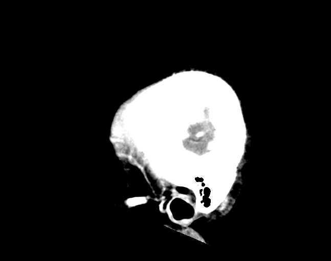 File:Cerebellar hemorrhage (Radiopaedia 37000-38671 Sagittal C+ 5).png