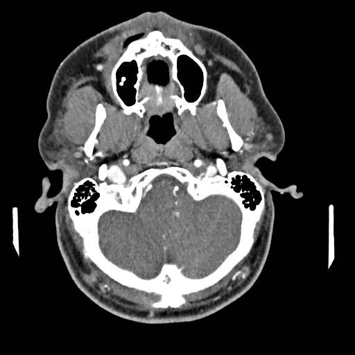 Cerebellar infarct due to vertebral artery dissection with posterior fossa decompression (Radiopaedia 82779-97029 C 39).png