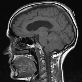 File:Cerebellar metastases (Radiopaedia 24038-24249 Sagittal T1 7).jpg