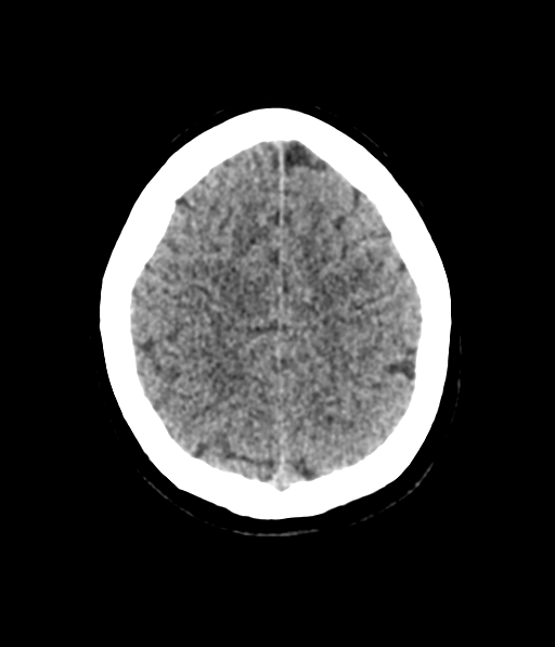 Cerebellar metastases - colorectal adenocarcinoma (Radiopaedia 40947-43652 Axial non-contrast 54).png