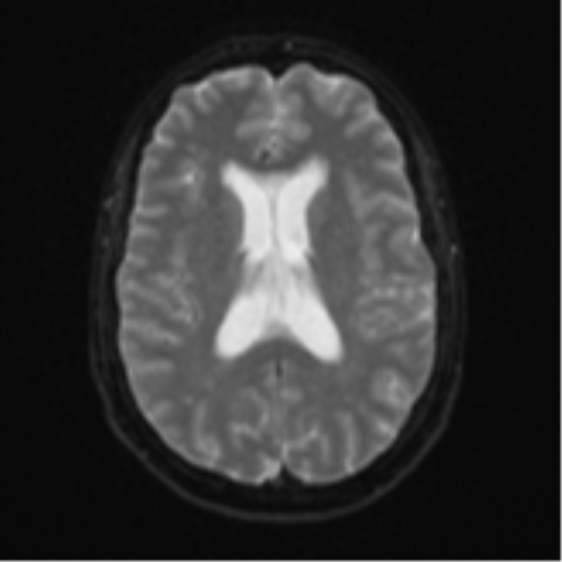 Cerebellar metastasis (Radiopaedia 51137-56765 Axial DWI 17).png