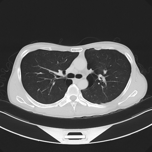Cerebellar metastasis - adenocarcinoma lung (Radiopaedia 63184-71717 Axial lung window 27).png