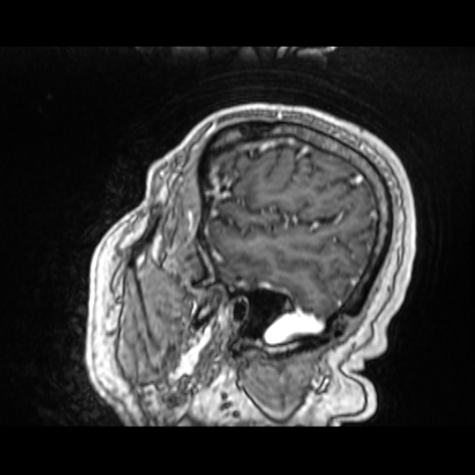 Cerebellar metastasis of pulmonary adenocarcinoma, cavernous venous malformation, and developmental venous anomaly (Radiopaedia 85827-101661 Sagittal T1 C+ 78).jpg