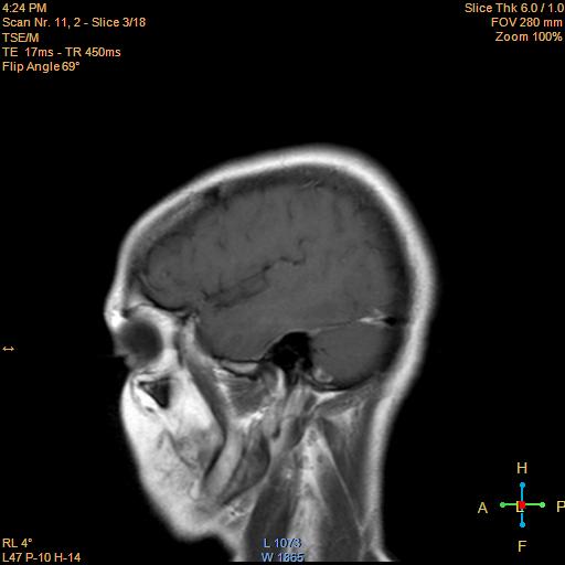 File:Cerebellopontine angle meningioma (Radiopaedia 22488-22525 Sagittal T1 C+ 3).jpg