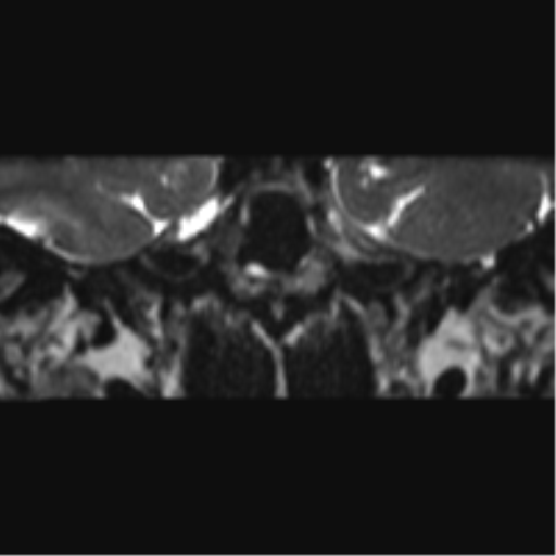 Cerebellopontine angle meningioma (Radiopaedia 48434-53348 Coronal T2 67).png