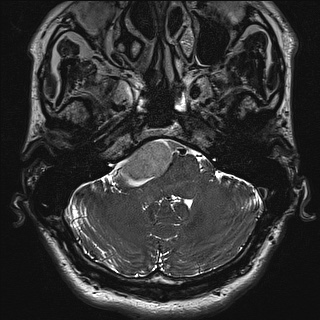 Cerebellopontine angle meningioma (Radiopaedia 72983-83680 Axial FIESTA 16).jpg