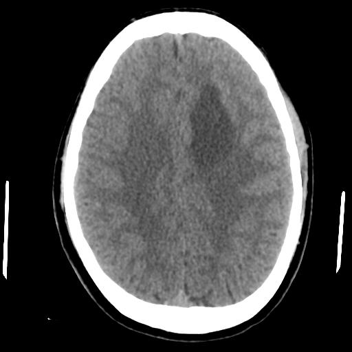 Cerebral abscess (Radiopaedia 29451-29919 Axial non-contrast 34).jpg
