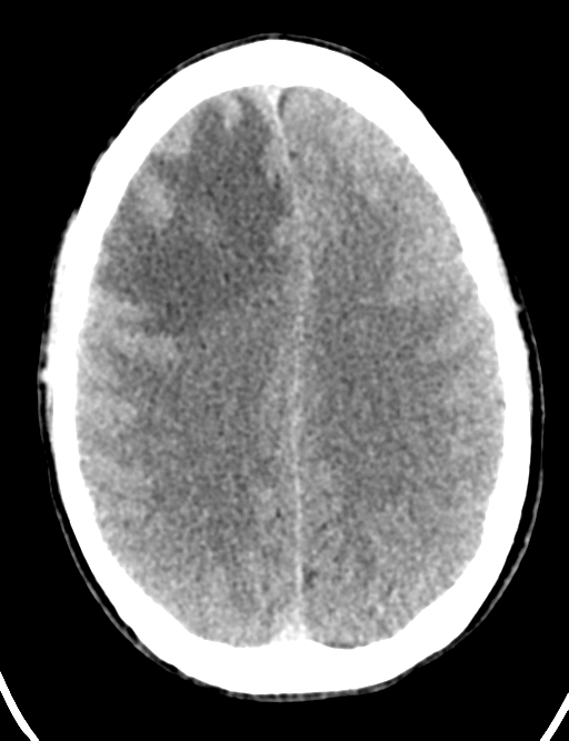 Cerebral abscess (Radiopaedia 60342-68008 Axial non-contrast 35).png