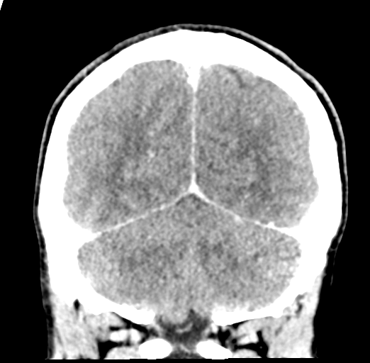 Cerebral abscess (Radiopaedia 60342-68008 Coronal C+ delayed 51).png
