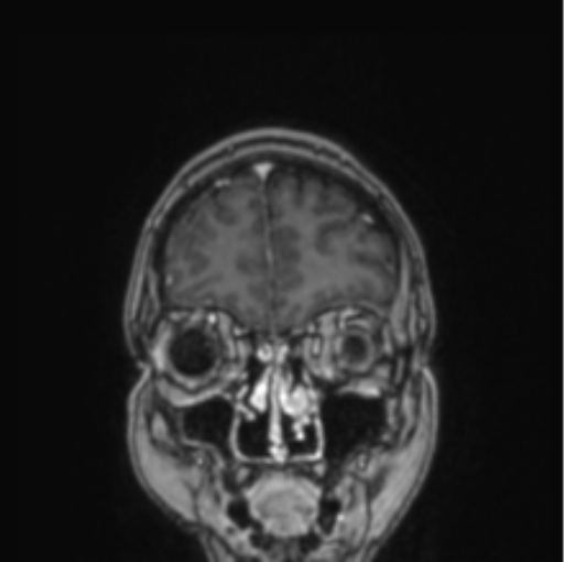 Cerebral abscess from pulmonary arteriovenous malformation (Radiopaedia 86275-102291 L 75).png