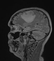 Cerebral abscess from pulmonary arteriovenous malformation (Radiopaedia 86275-102291 Sagittal FLAIR 48).png
