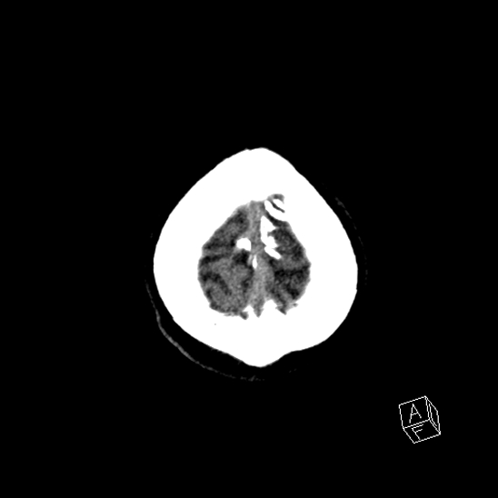 File:Cerebral abscess with ventriculitis (Radiopaedia 78965-91876 Axial non-contrast 47).jpg