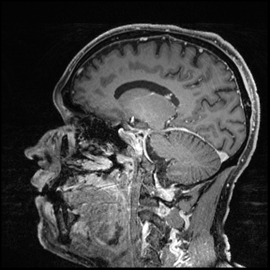 Cerebral abscess with ventriculitis (Radiopaedia 78965-91878 Sagittal T1 C+ 77).jpg