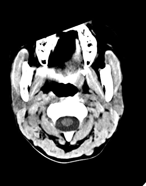 Cerebral abscesses (Radiopaedia 70458-80568 Axial non-contrast 4).jpg