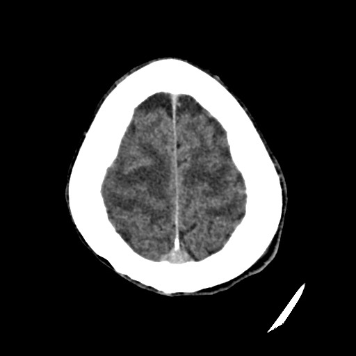 File:Cerebral amyloid angiopathy-related inflammation (Radiopaedia 74836-85848 Axial non-contrast 52).jpg