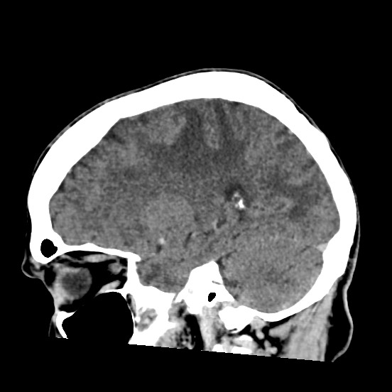 Cerebral amyloid angiopathy-related inflammation (Radiopaedia 74836-85848 C 21).jpg